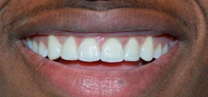 Smile after composite bonding