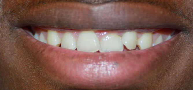 Smile before composite bonding
