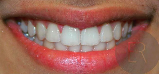 Smile after Invisalign treatment