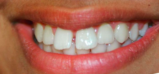 Smile before Invisalign treatment