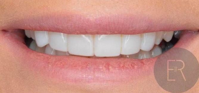 Smile after composite bonding — case three