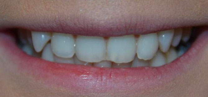 Smile before composite bonding — case three